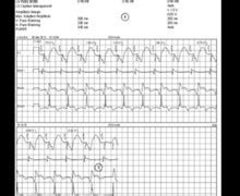 Quadripolar LV lead threshold test 